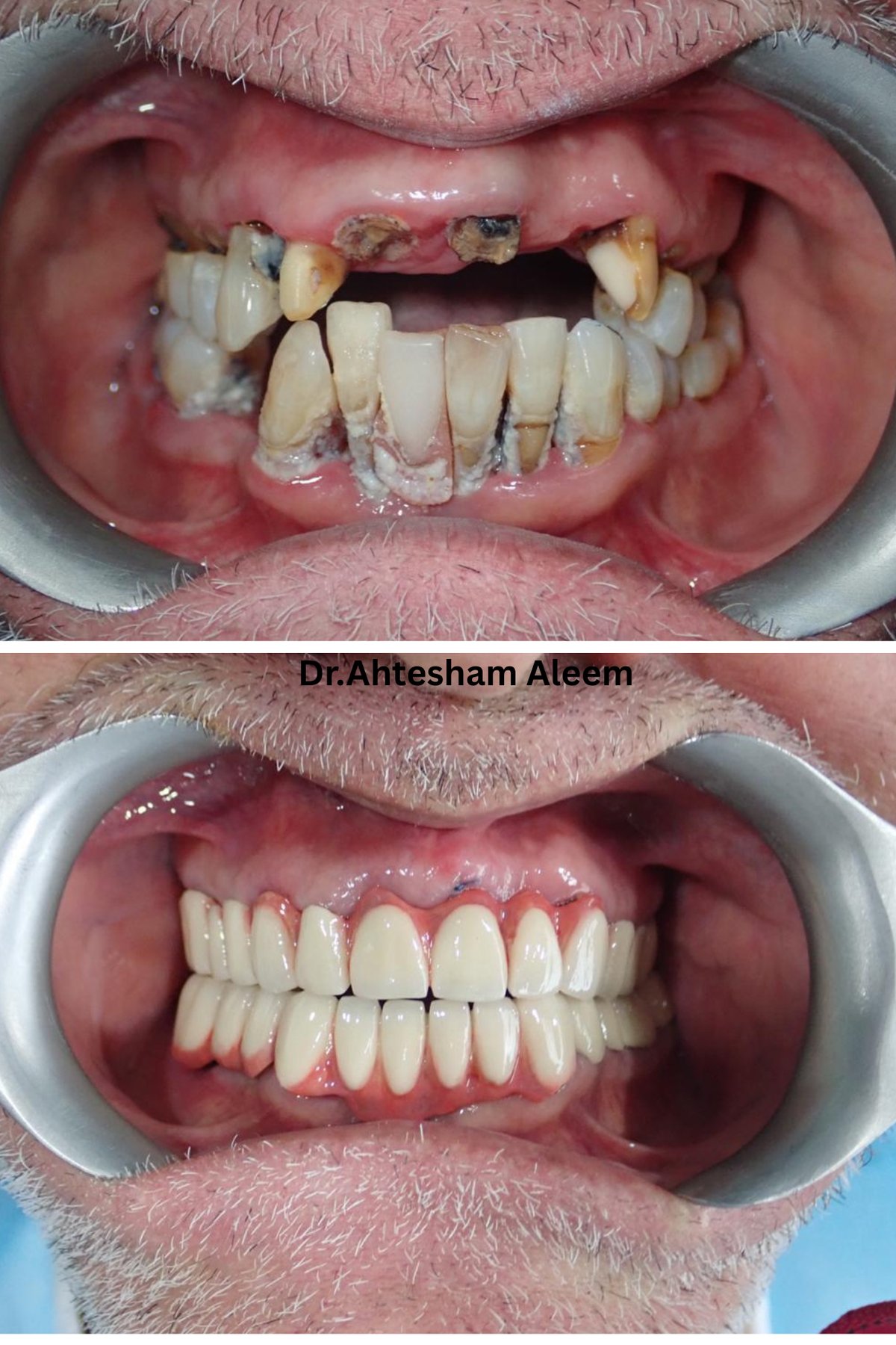 A radiant new smile crafted through our advanced full-mouth rehabilitation and cosmetic dentistry, bringing back form and function.