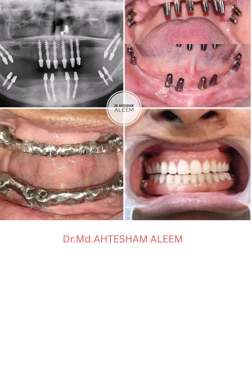 Jaw Cyst Surgery