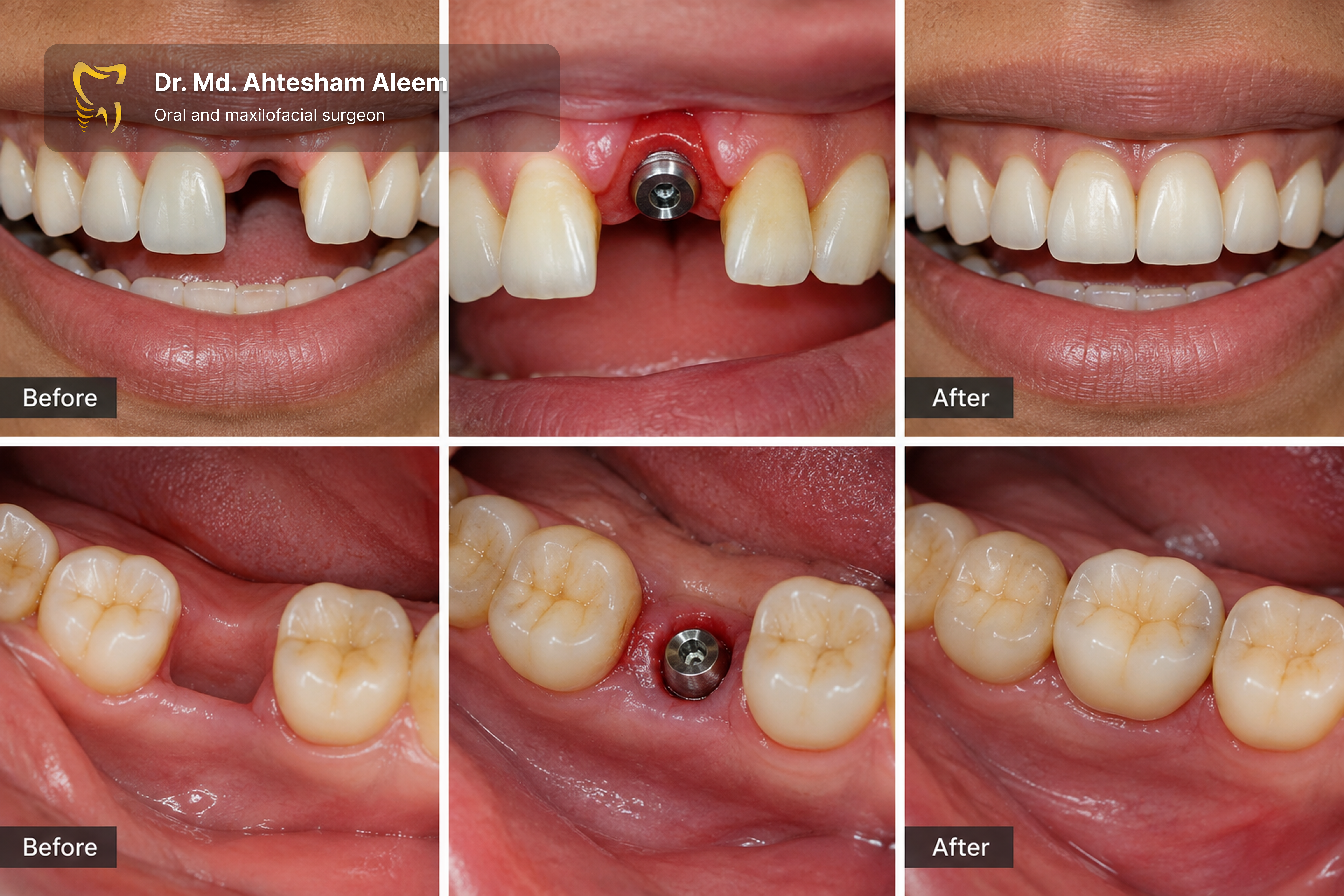 Immediate Implant Placement Image 1