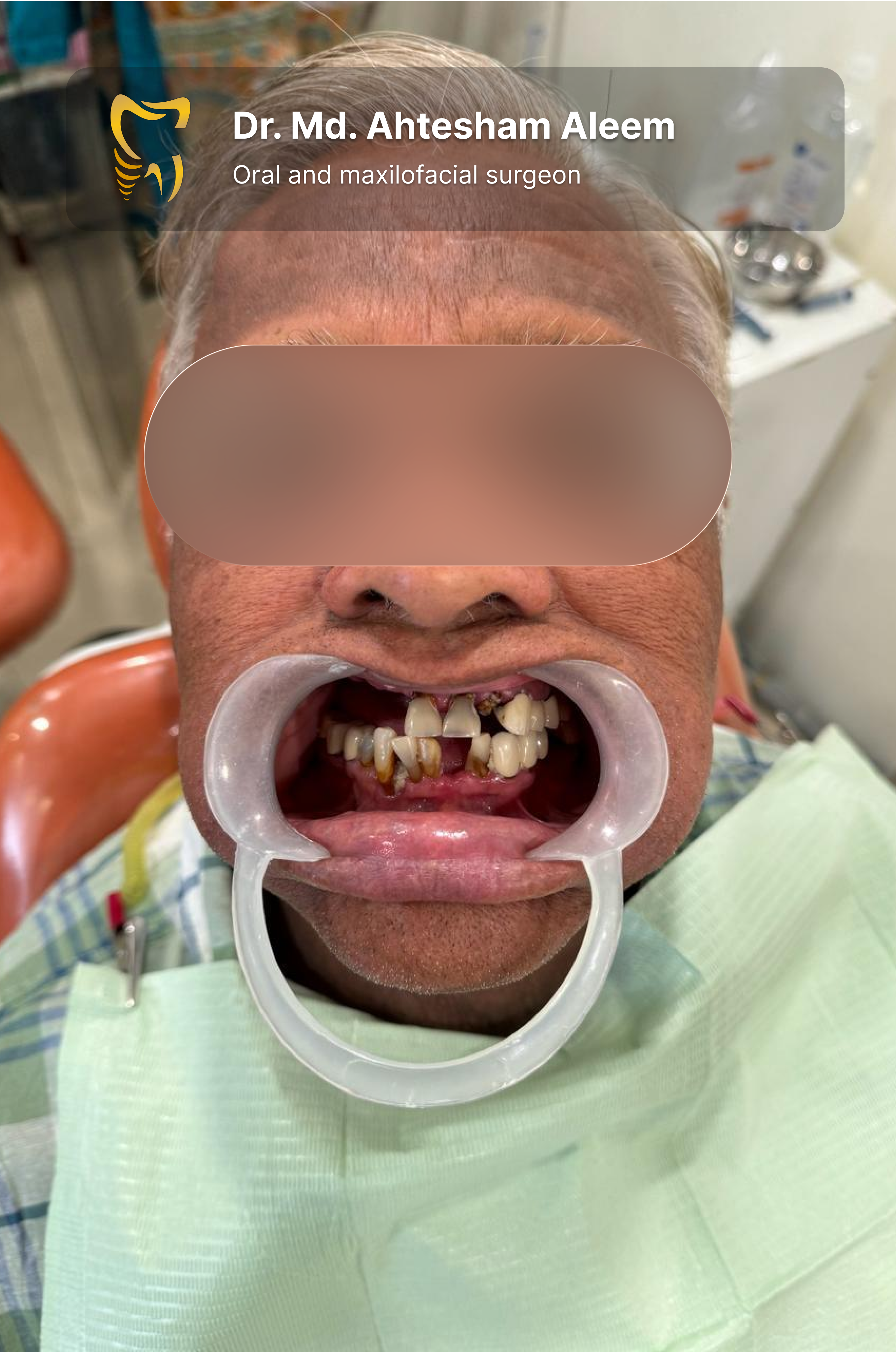 Overdenture