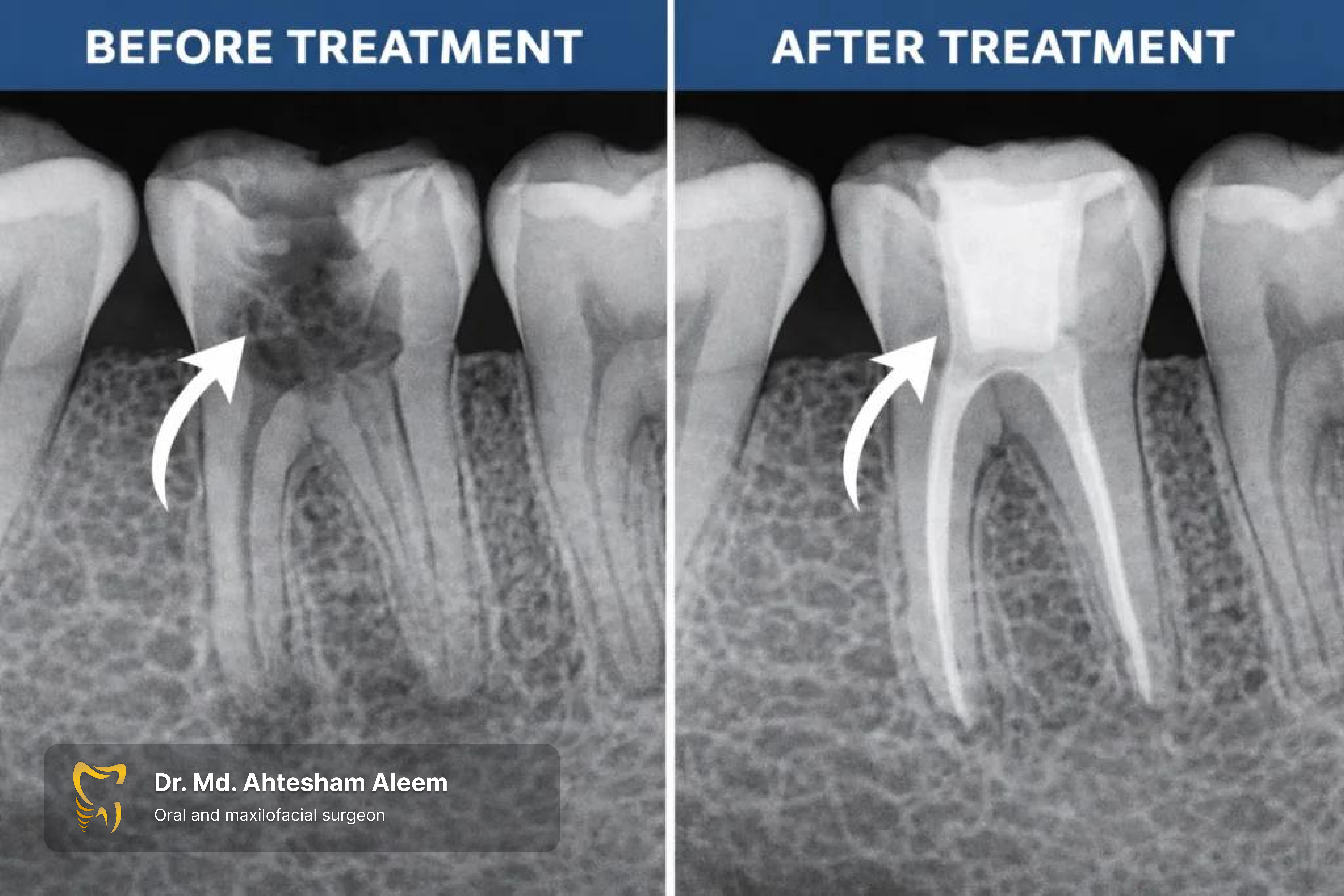 Root Canal Treatment Image 1