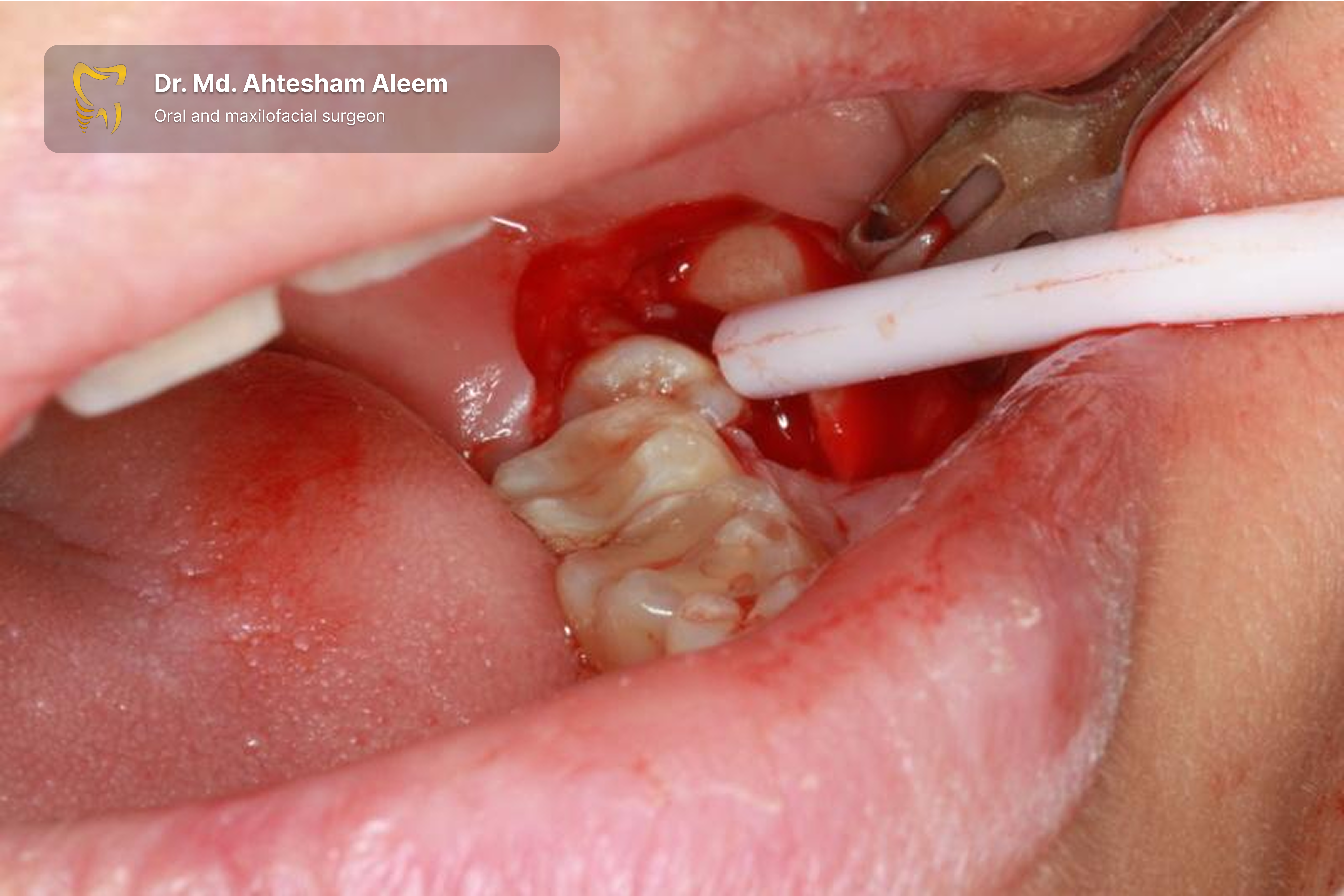 Impacted Tooth Surgery Image 1