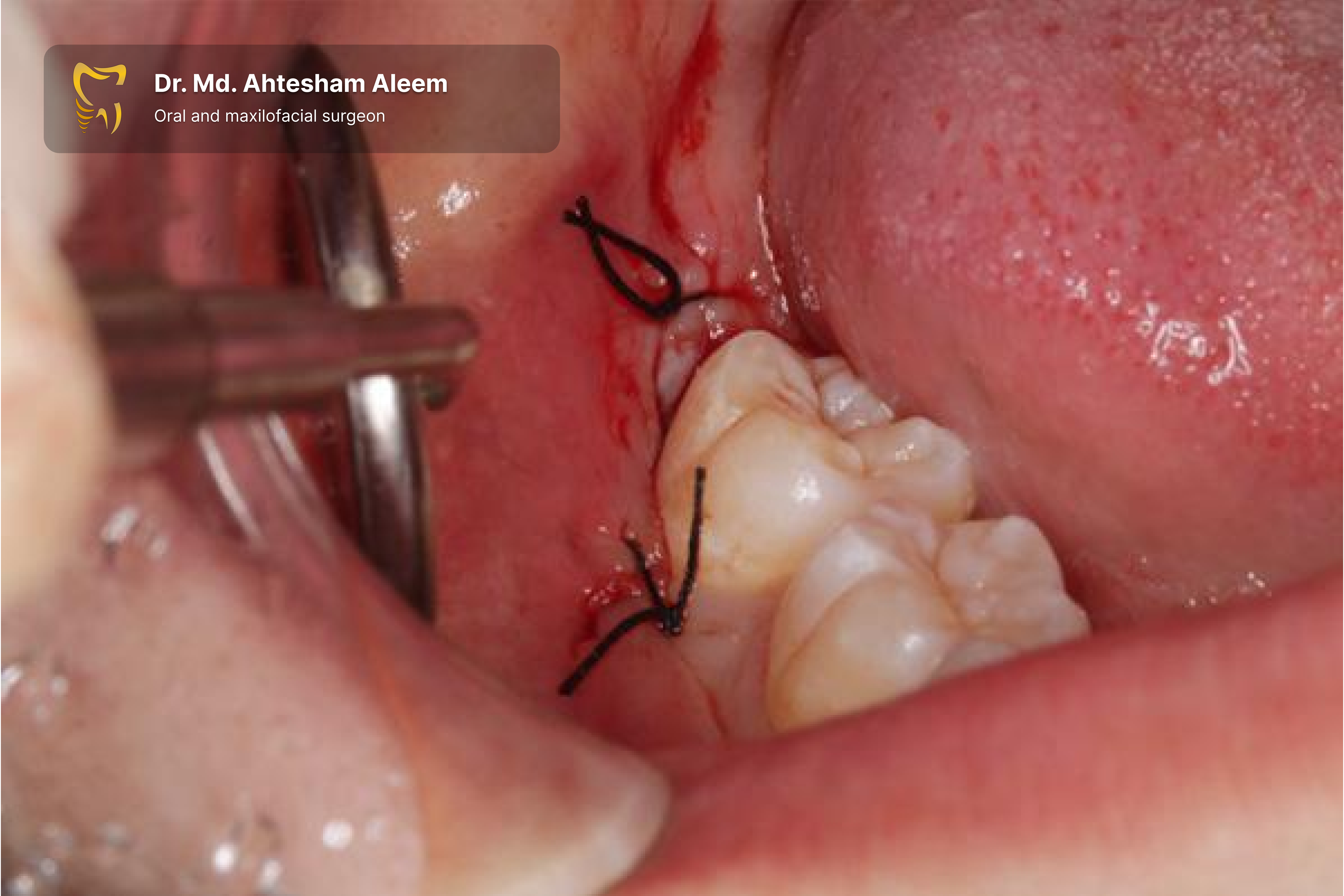 Impacted Tooth Surgery Gallery 2