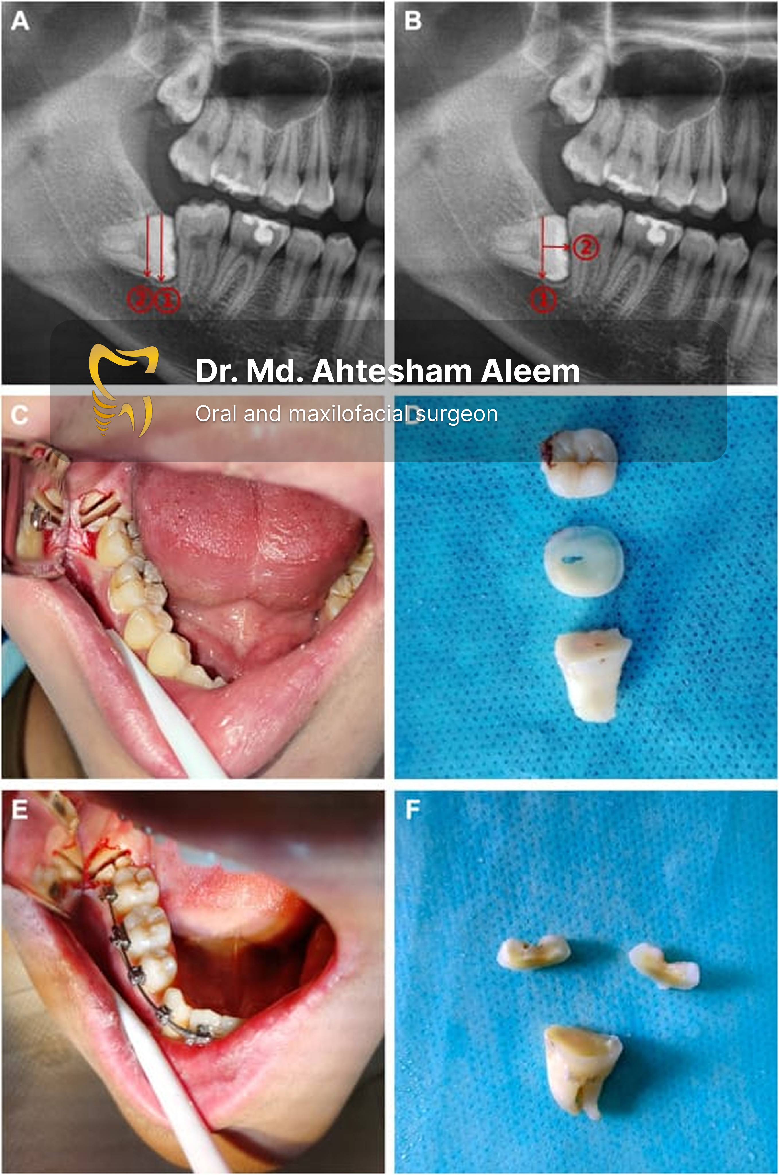 Impacted Tooth Surgery Gallery 3